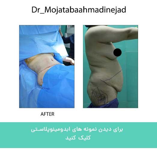 ابدومینوپلاستی