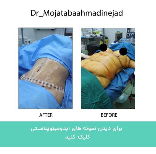 ابدومینوپلاستی 2